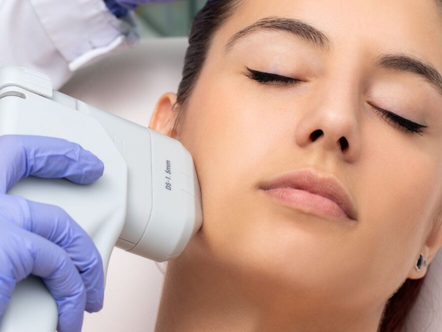 Remoción Laser