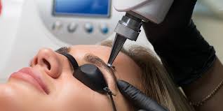 Remoción Laser